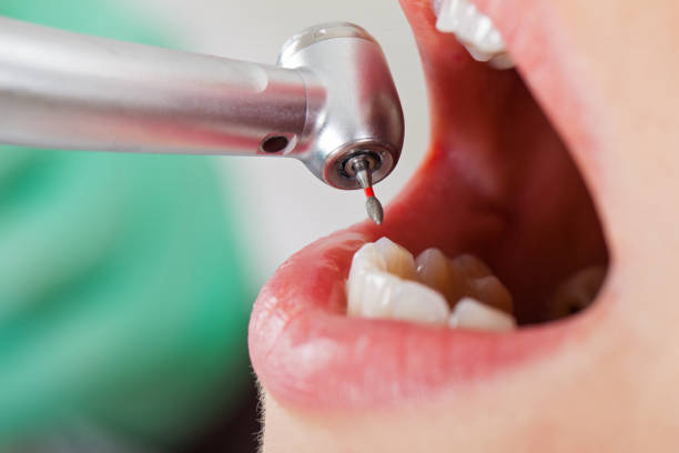 Best Emergency Treatment for Dental Infections or Abscesses in Kennett Square, PA